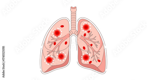 Illustration of diseased lungs showing areas of infection or damage, medical concept