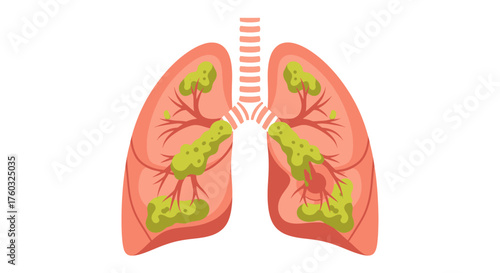 Illustration of human lungs showing signs of illness with green patches indicating infection or disease