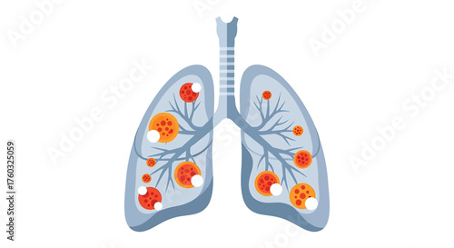 Pulmonary Affliction Detailed Vector Illustration of Damaged Lungs with Pathogens