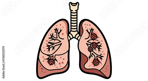 Clear medical illustration of human lungs affected by severe respiratory disease, featuring cancerous tumors and lesions. Ideal for health education, medical awareness, and pathology studies