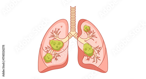 Anatomical illustration of human lungs with cancerous tumors, showing the progression of malignant neoplasms in the respiratory system.