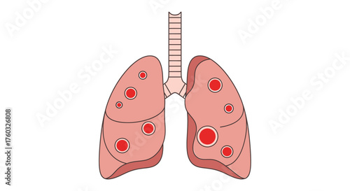 Illustration of lungs with red spots, possibly indicating a disease.