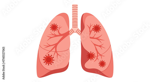 Anatomical illustration of human lungs infected with a virus, representing a respiratory disease like COVID-19 or pneumonia.