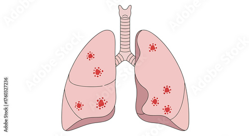 Illustration of human lungs showing multiple red circular virus-like particles scattered throughout both lung lobes.