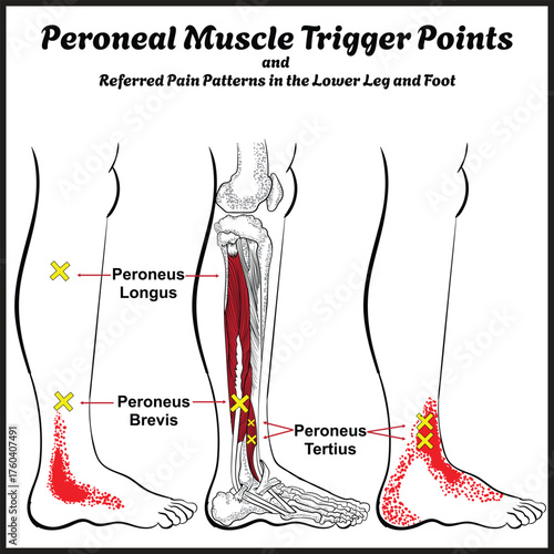 Peroneal Muscle Trigger Points and Referred Pain Patterns in the Lower Leg and Foot