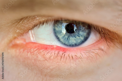 Lower eyelid showing painful red bump caused by stye bacterial infection or demodex mite inflammation resulting in swollen skin and irritation near the eyelashes. Eyelid stye closeup. Selective focus