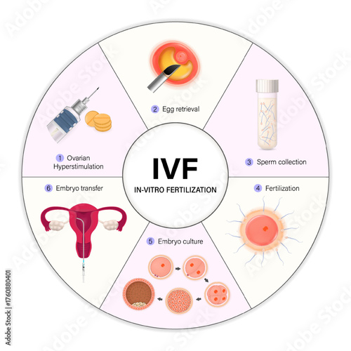 In-Vitro Fertilization. IVF Process Step-by-Step. Fertility treatment. Assisted reproductive technology.