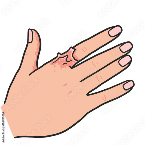 Hand with skin irritation showing redness and peeling on finger  