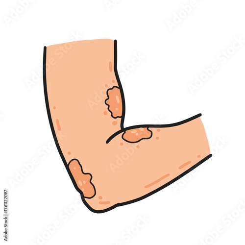 Illustrated elbow with skin condition and patches of dryness  