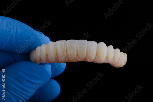 Full dental zirconium prosthesis on titanium bar stained with stains for ceramic.