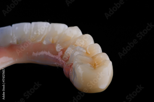 Full dental zirconium prosthesis on titanium bar stained with stains for ceramic.