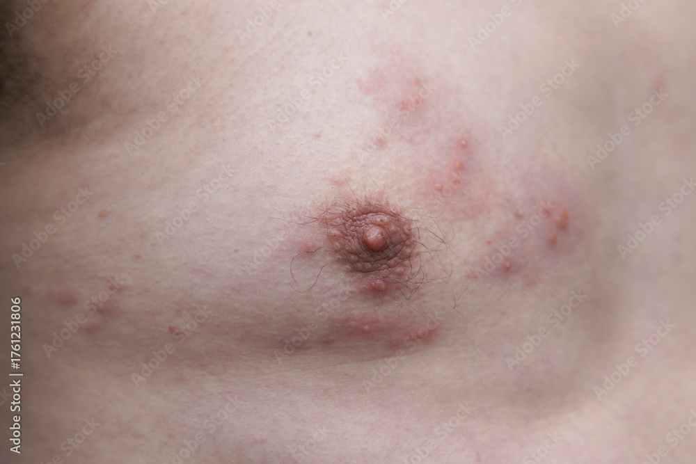 Fototapeta premium Close-up image showing the skin rash and blisters typical of Shingles Herpes Zoster. Used for medical education, dermatology reference, and awareness of viral skin infections.