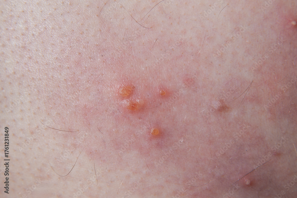 Fototapeta premium Close-up image showing the skin rash and blisters typical of Shingles Herpes Zoster. Used for medical education, dermatology reference, and awareness of viral skin infections.