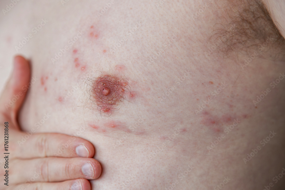 Fototapeta premium Close-up image showing the skin rash and blisters typical of Shingles Herpes Zoster. Used for medical education, dermatology reference, and awareness of viral skin infections.