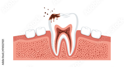 Understanding the various stages and causes of tooth decay and its progression into a severe dental problem.