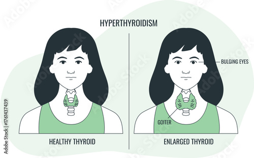 Hyperthyroidism comparison showing healthy and enlarged thyroid with symptoms Keywords: thyroid, healthy thyroid, enlarged thyroid, goiter, bulging eyes, hyperthyroidism, human anatomy, endocrine