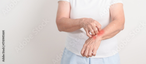 Fotografía Elderly woman itching arm and body scratching for Skin Allergy from insect bite and food dermatitis