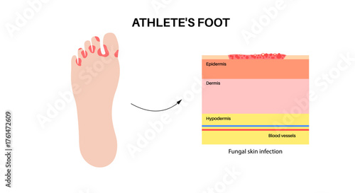 Athletes foot inflammation