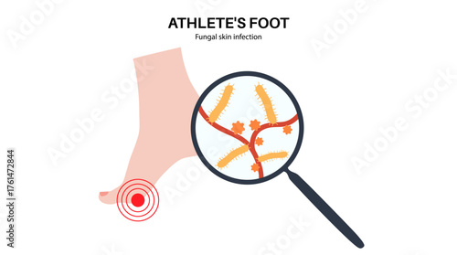 Athletes foot inflammation