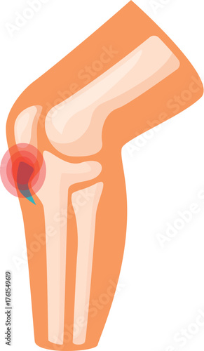Medical illustration showing painful knee joint, useful for healthcare and medical topics