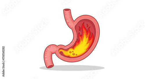Illustration of a Human Stomach with Flames Indicating Acid Reflux or Heartburn.