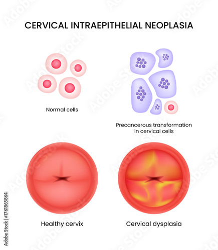 Cervical Intraepithelial Neoplasia Normal Cells to Dysplasia