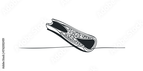 Cross Section of Artery with Atherosclerosis Plaque