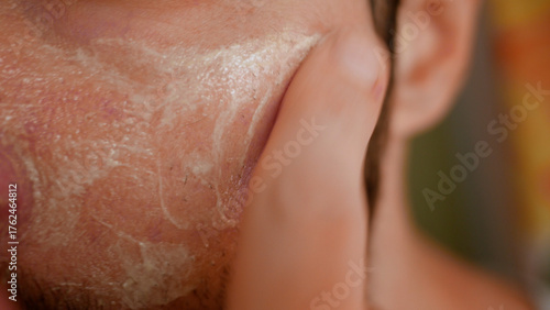 Man Applies Acne or Rosacea Topical Cream