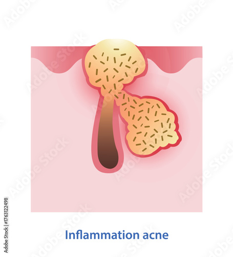 Diagram of inflammation acne on skin layer vector illustration. P. acnes bacteria break down oil, it causes increased production of inflammatory, lead to red bumps and pustules. Skin anatomy concept.