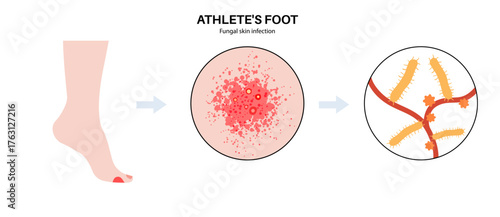 Athletes foot inflammation