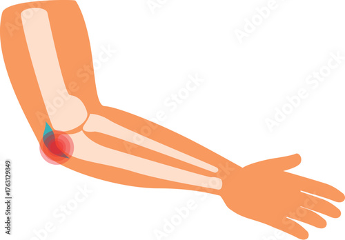 Human arm with elbow pain, showing bones and joint inflammation