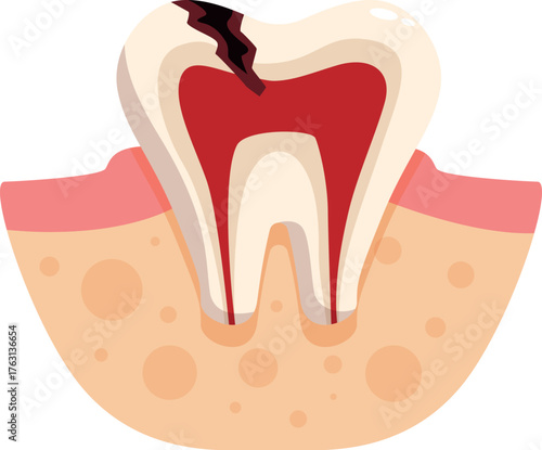 Cross section of molar showing inflammation of the pulp, periodontitis and caries affecting enamel and dentin