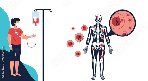 Medical illustration of a patient undergoing treatment for blood cancer affecting the skeletal system.