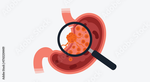 Magnifying glass reveals stomach cancer cells in human organ illustration.