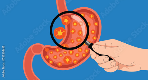 Medical illustration of stomach cancer cells under magnification for diagnosis.