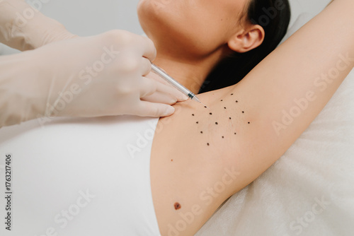 Εκτύπωση καμβά Intradermal injection procedure for underarm hyperhidrosis