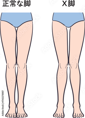 正常な脚とX脚のセット