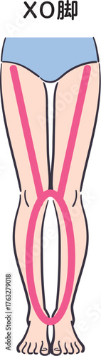 若い女性の脚（XO脚）補助線あり