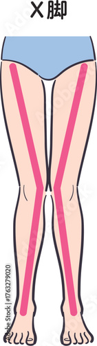 若い女性の脚（X脚）補助線あり