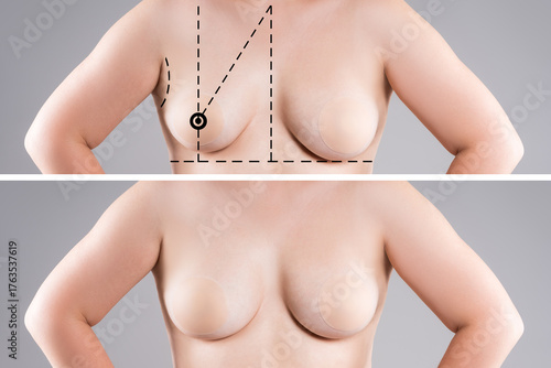 Before and after breast augmentation, woman with asymmetric saggy breasts, reduction mammoplasty, aesthetic plastic surgery, healthcare and medicine concept