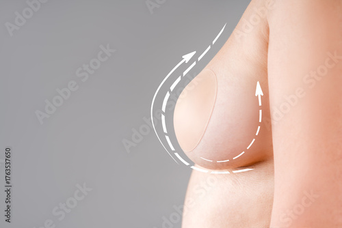 Breast augmentation, saggy breast before aesthetic lifting procedure, reduction mammoplasty, plastic surgery, healthcare and medicine concept on gray background