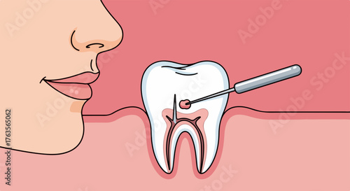 Root canal treatment shown on tooth cross section with dental instrument cleaning infected pulp. Tooth anatomy reveals intricate structure. Root canal treatment involves removing decay, nerve tissue.