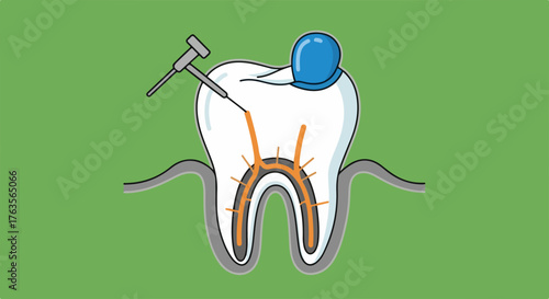 Dental root canal procedure illustration showing treatment of infected tooth pulp. Diagram details nerve canals and surgical drill during root canal procedure preparation.
