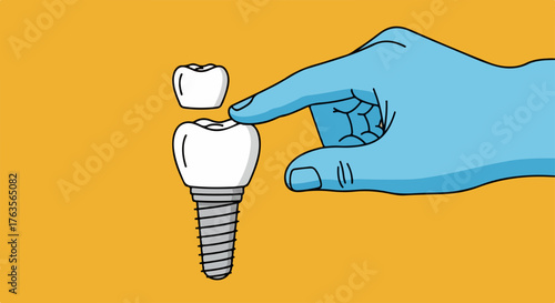 Illustration depicts dental implant, blue hand places crown on tooth screw. Dental implant construction shows finger guides cap to titanium post. Concept dental implant for patient education,