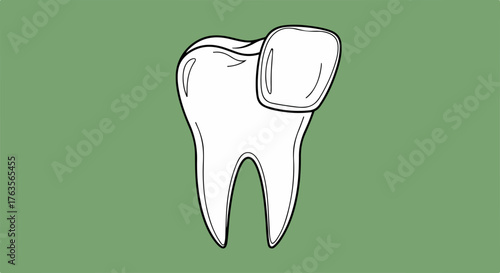 Tooth crown restoration depicted in medical illustration showing replacement tooth cap. Tooth crown fitting illustrates process of dental care.