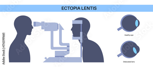 Ectopia lentis disease