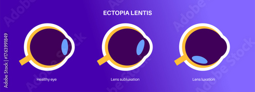 Ectopia lentis disease