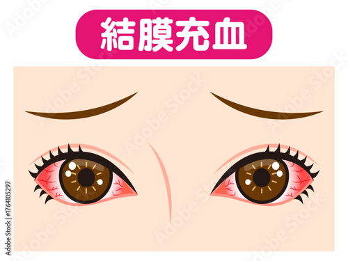 	結膜充血で充血した両目のイラスト素材