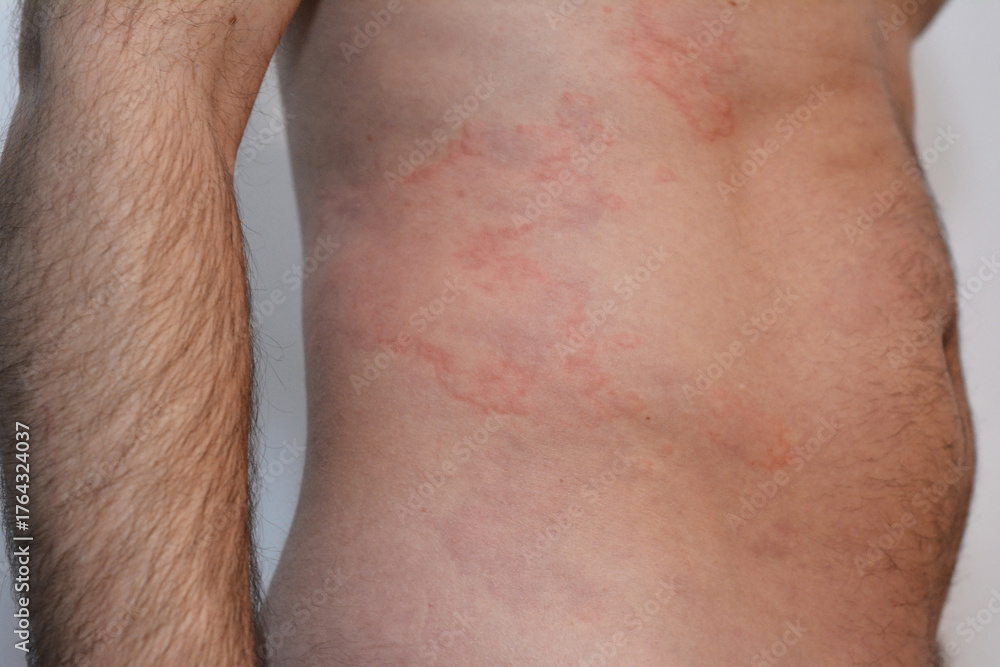 Fototapeta premium Skin rashes on a man's body due to a severe allergy.