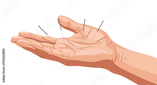 Acupuncture treatment on the palm of a hand for pain relief and wellness.
